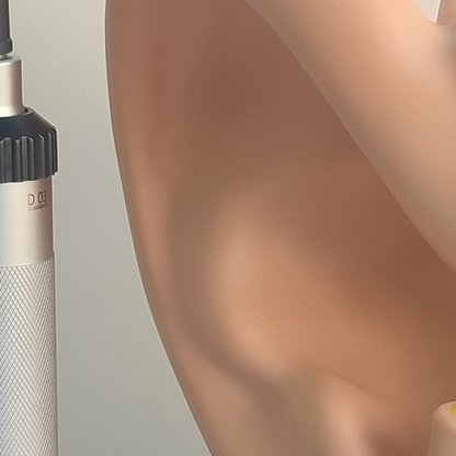 Лікування отогематоми