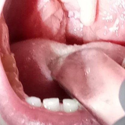 Лікування хронічного тонзиліту